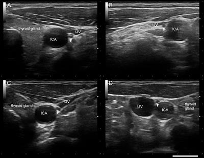 Axonal Degeneration of the Vagus Nerve in Parkinson's Disease—A High-Resolution Ultrasound Study